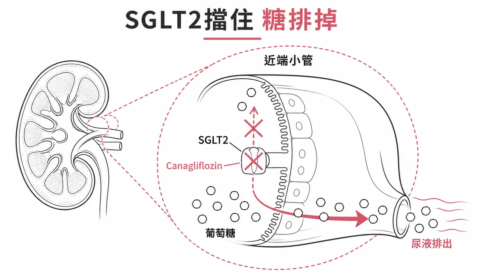 Canagliflozin抑制SGLT2讓葡萄糖從尿液排出示意圖