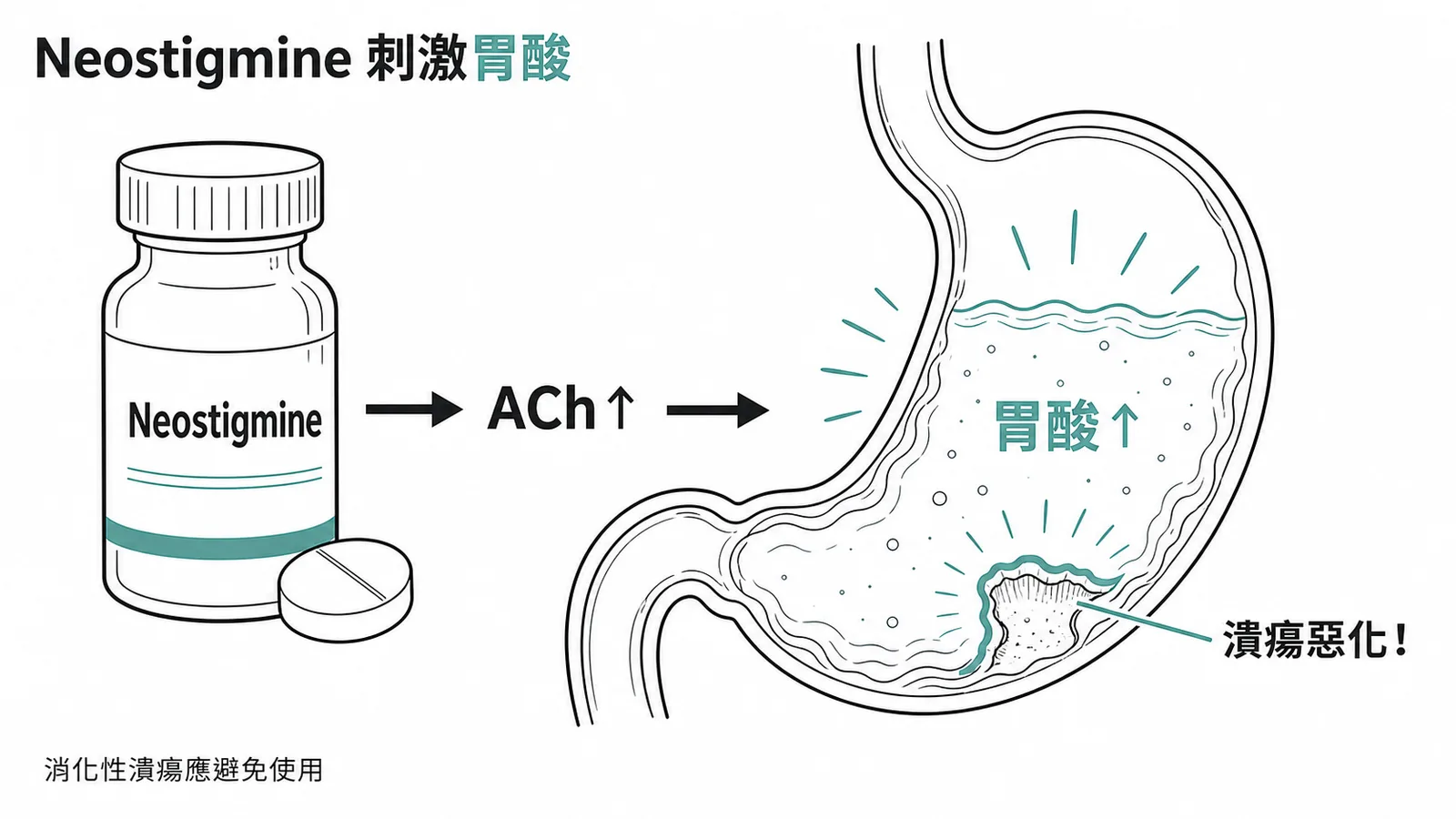 Neostigmine 增加乙醯膽鹼不適用於消化性潰瘍示意圖