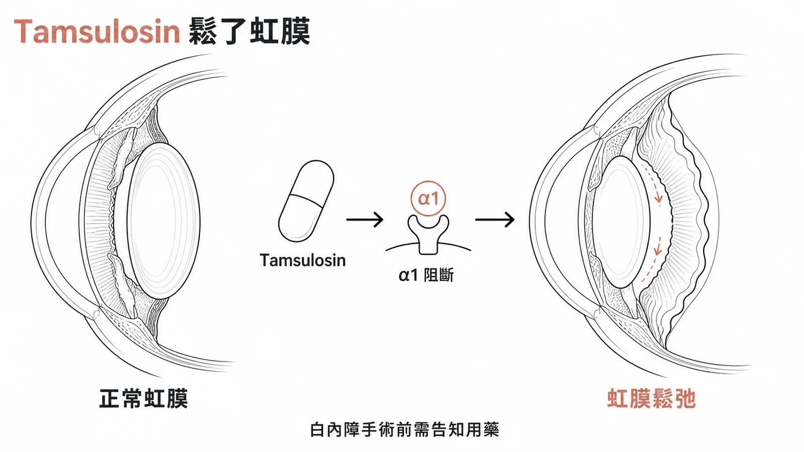 Tamsulosin 為 α1 阻斷劑導致虹膜鬆脫症候群示意圖