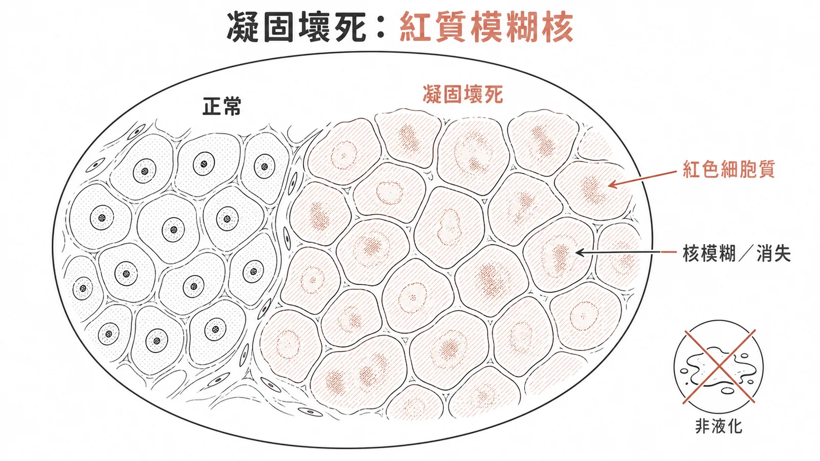 凝固性壞死呈現強烈嗜酸性紅色細胞質與模糊細胞核示意圖