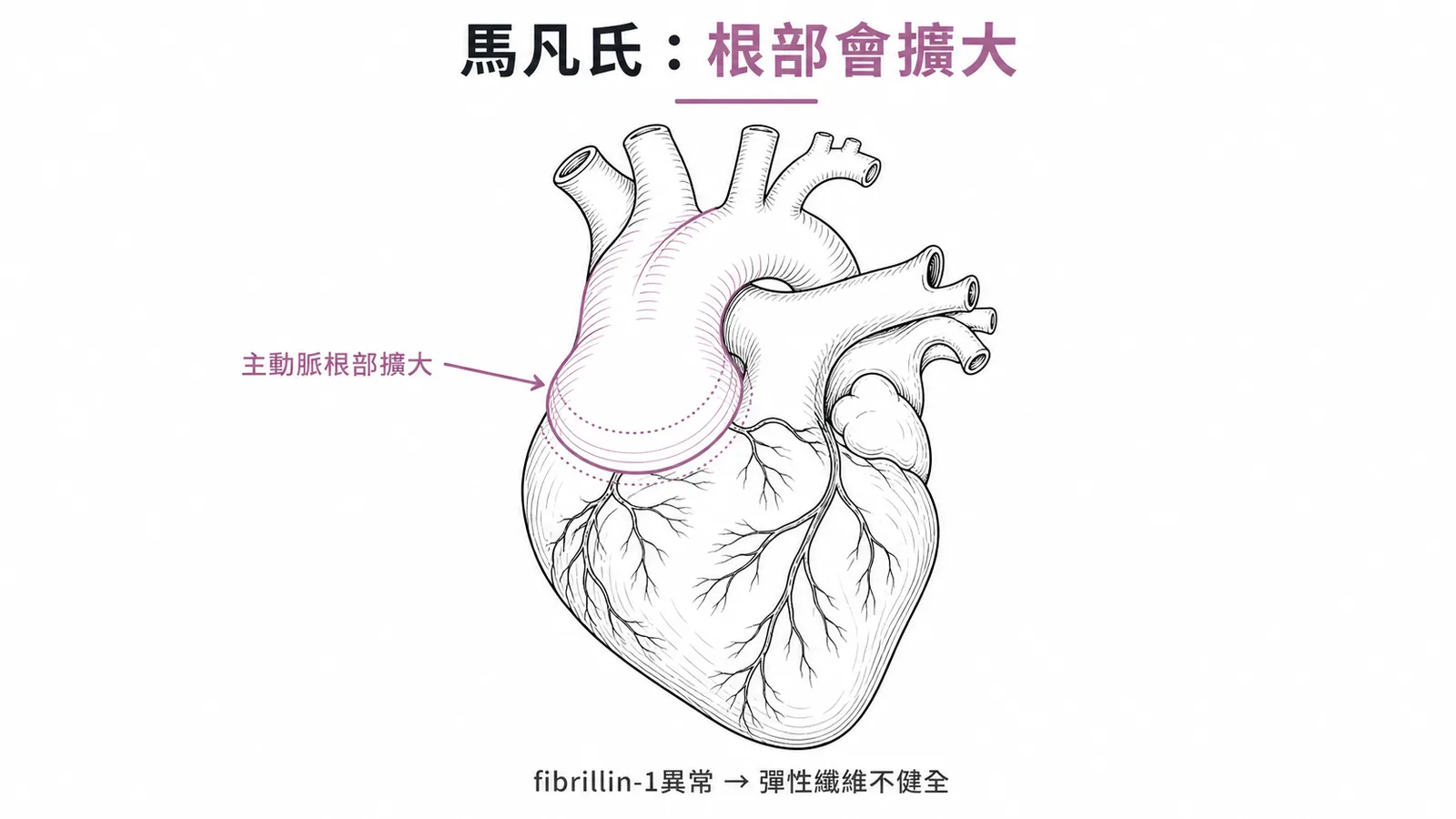 馬凡氏症候群主動脈根部擴大是最危險的心血管併發症