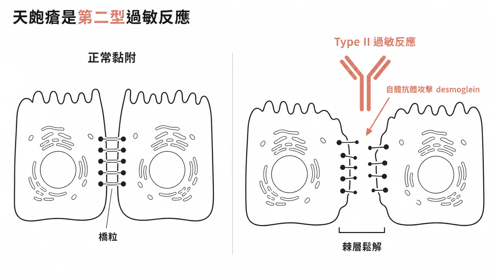 天皰瘡自體抗體攻擊橋粒desmoglein導致棘層鬆解屬第二型過敏反應
