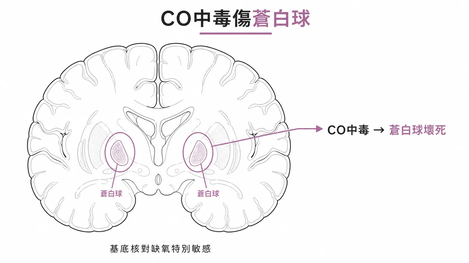 一氧化碳中毒主要傷害基底核蒼白球因其代謝率高對缺氧特別敏感