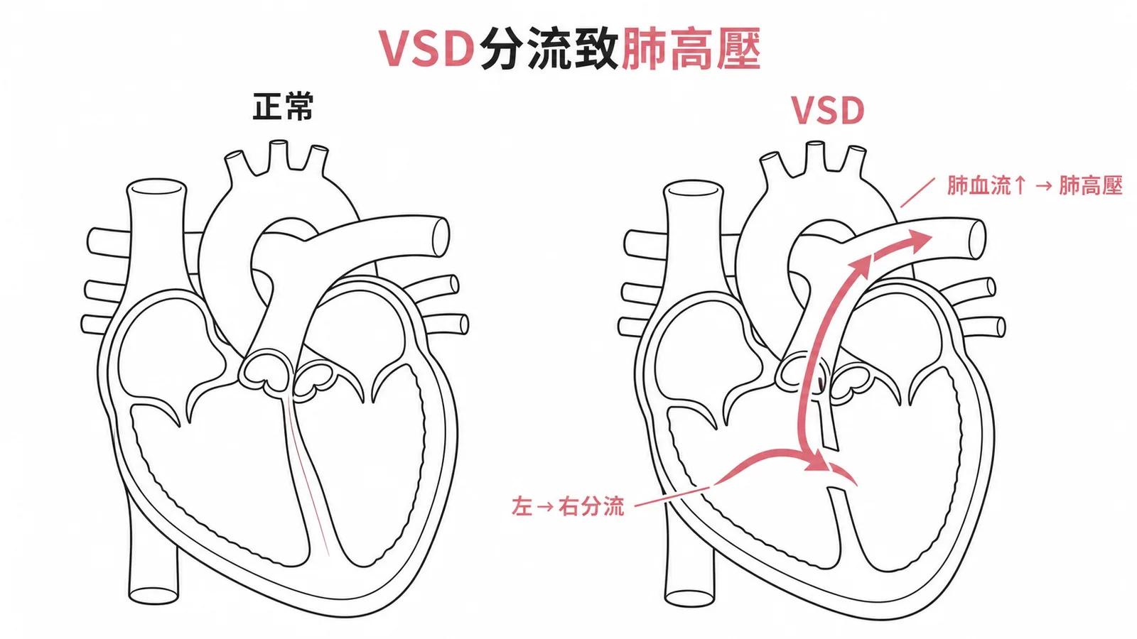 心室中隔缺損左向右分流使肺血流過多導致肺高壓
