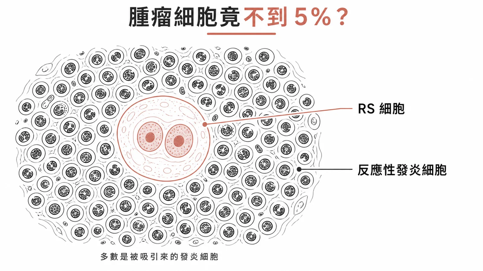 何杰金氏淋巴瘤組織中 Reed-Sternberg 細胞僅佔不到 5%，周圍大量為反應性發炎細胞