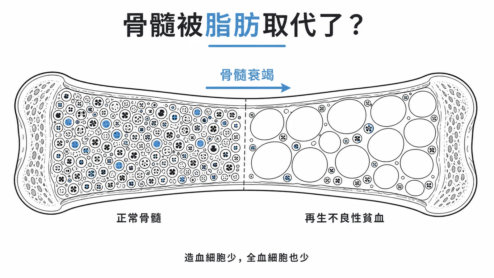 再生不良性貧血的骨髓造血細胞被脂肪組織取代，導致全血細胞減少