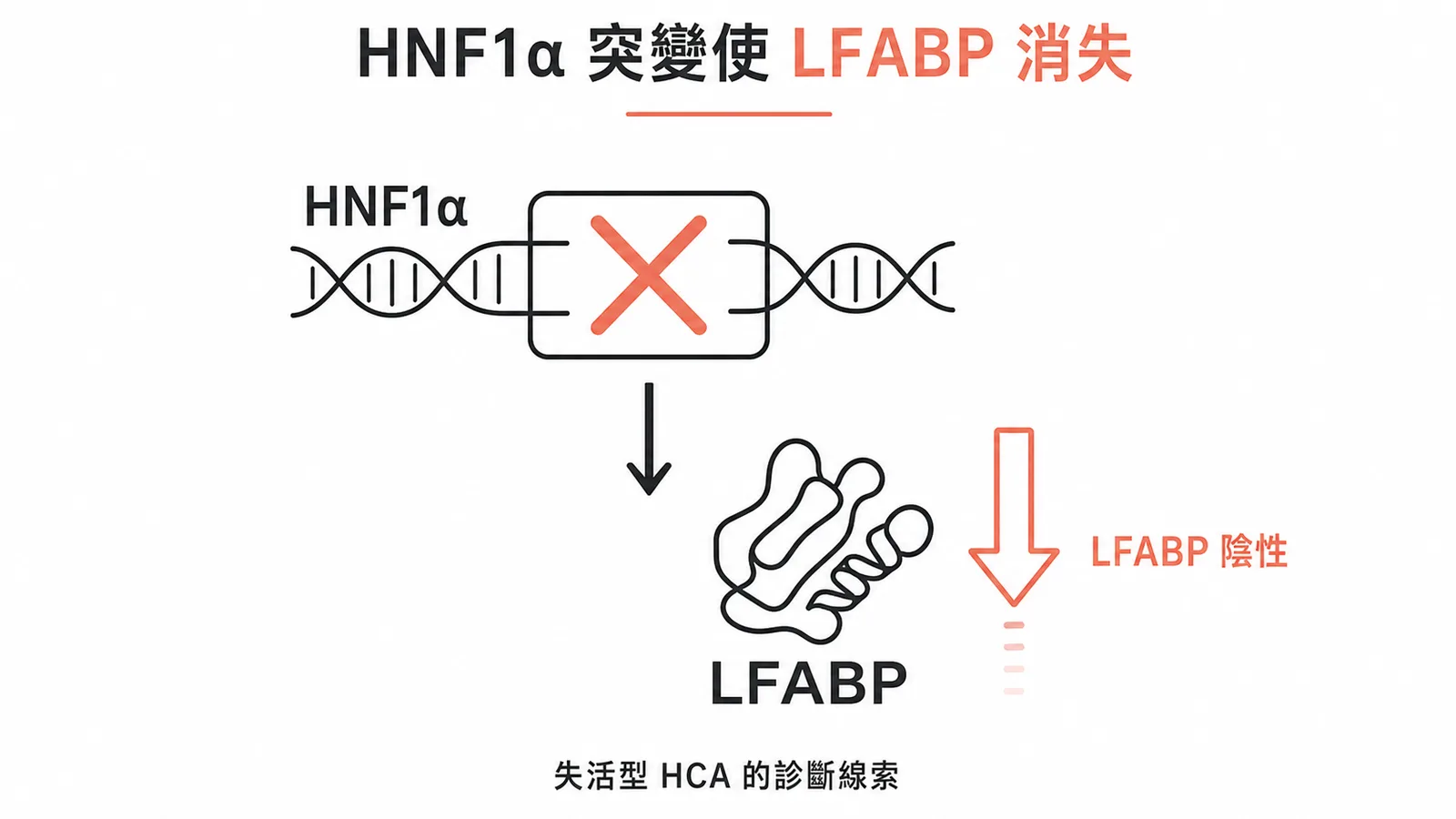 HNF1α 基因突變導致下游 LFABP 表達缺失,是診斷此型肝細胞腺瘤的免疫組化依據