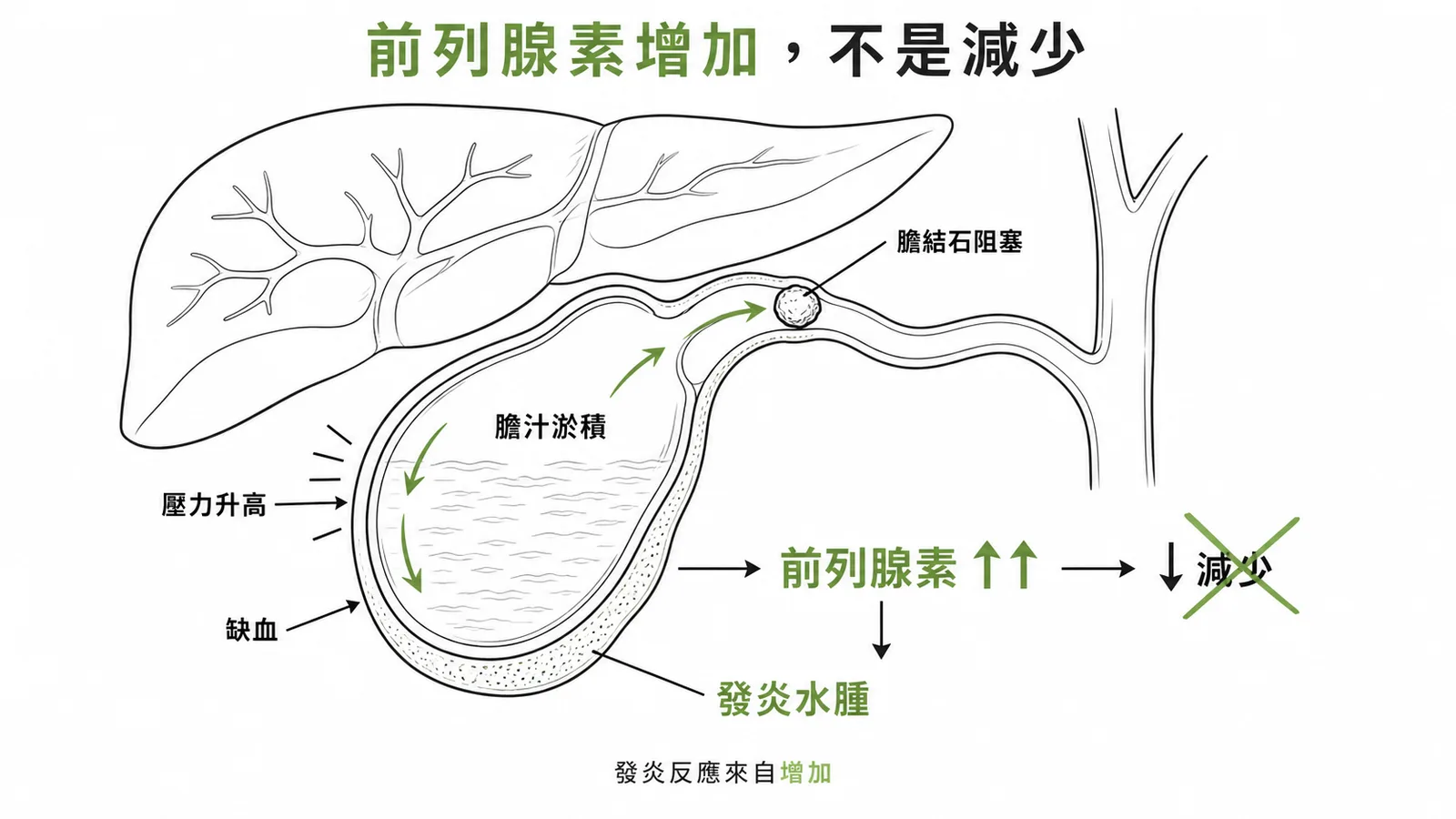 急性膽囊炎中膽結石阻塞導致前列腺素釋放增加而非減少