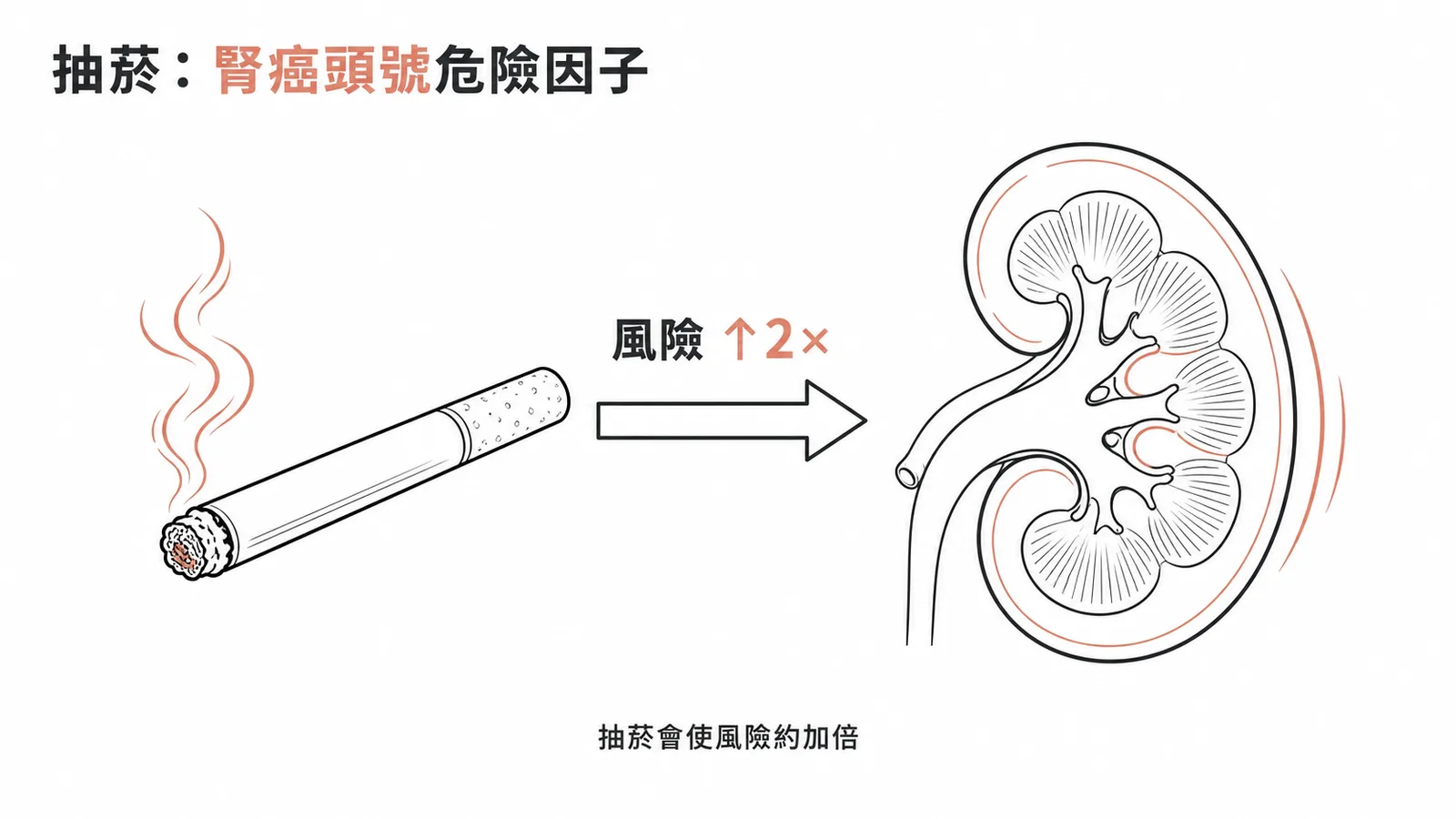 抽菸使腎細胞癌風險增加約兩倍