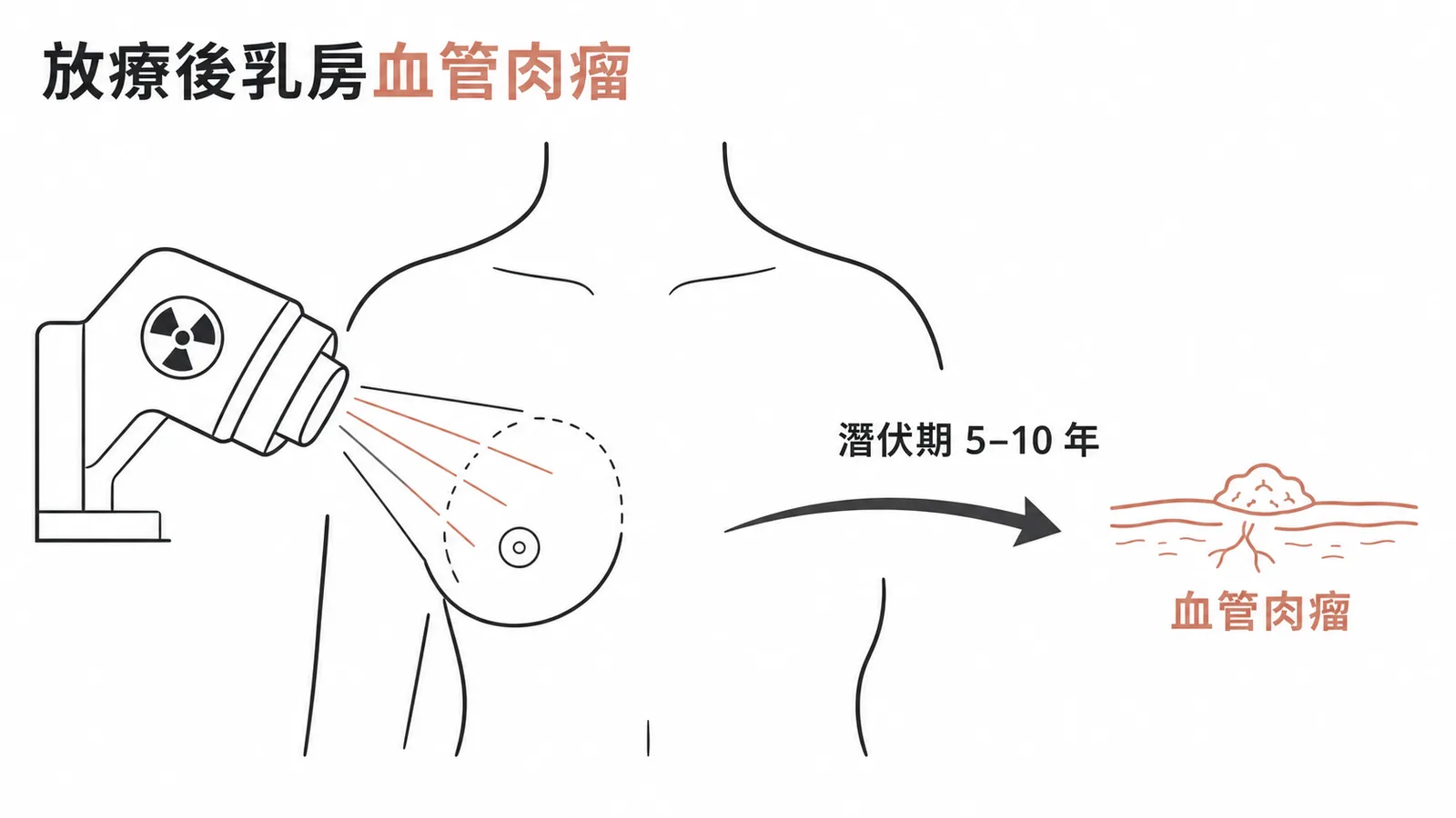 放射線治療後乳房最常見的繼發性惡性腫瘤為血管肉瘤