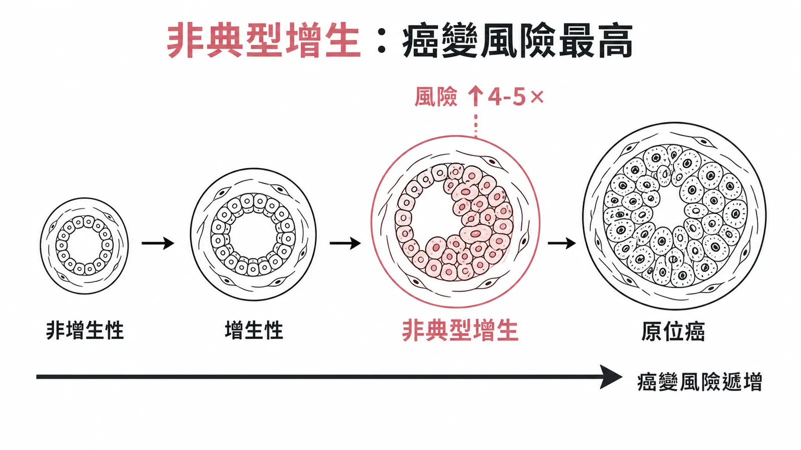 乳房病變癌變風險分級：非典型增生風險最高達四至五倍