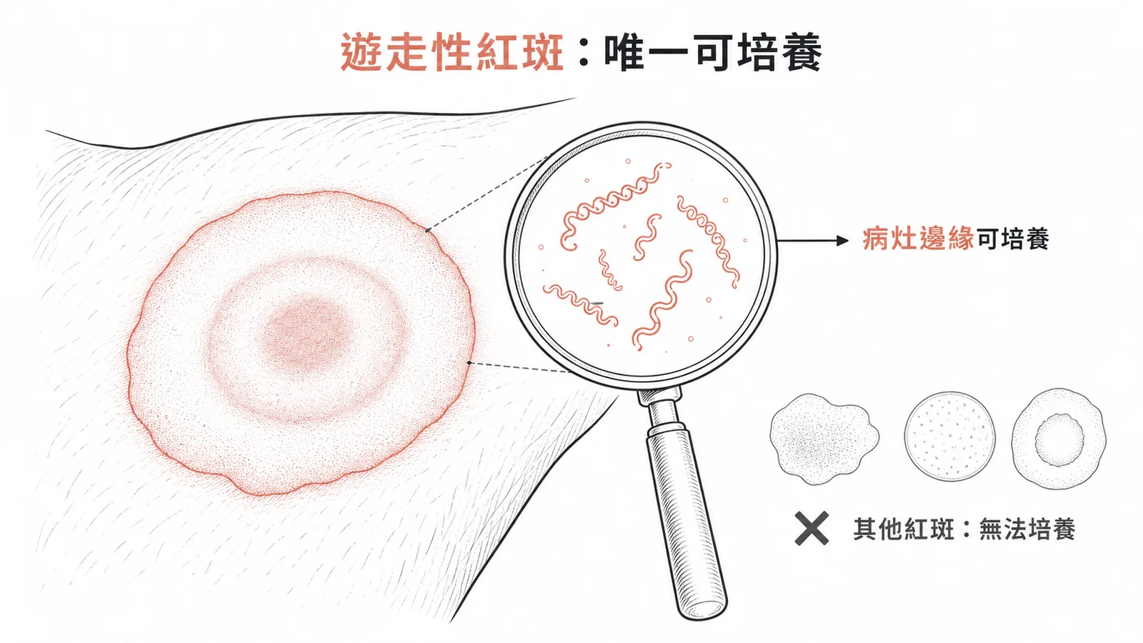 遊走性紅斑病灶邊緣可培養出Borrelia螺旋體菌