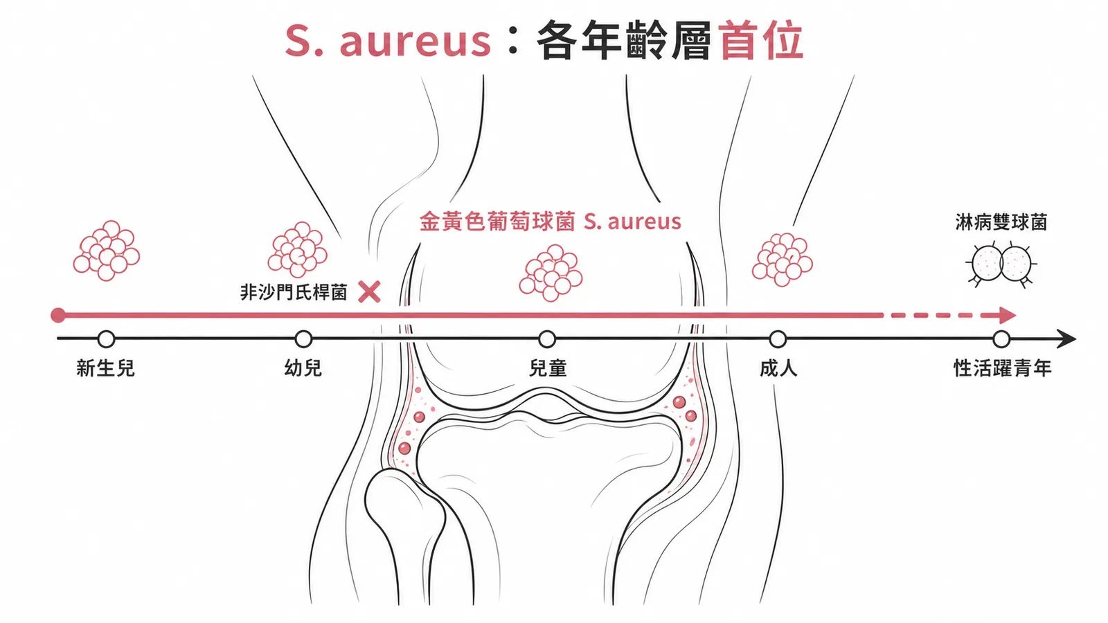 金黃色葡萄球菌為各年齡層化膿性關節炎首位致病菌
