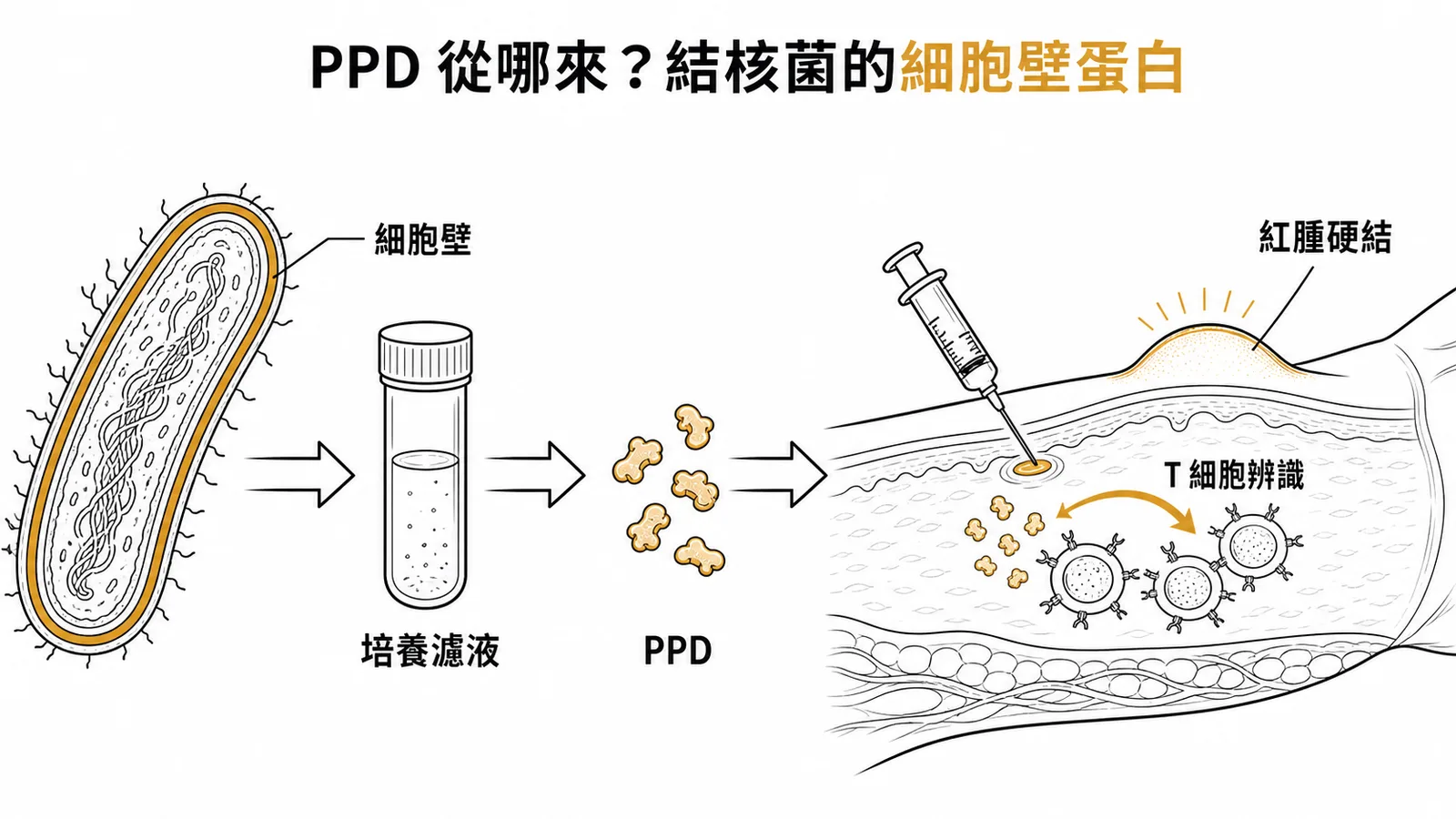 PPD 來源:結核桿菌細胞壁蛋白經培養濾液純化後皮內注射引發遲發型過敏