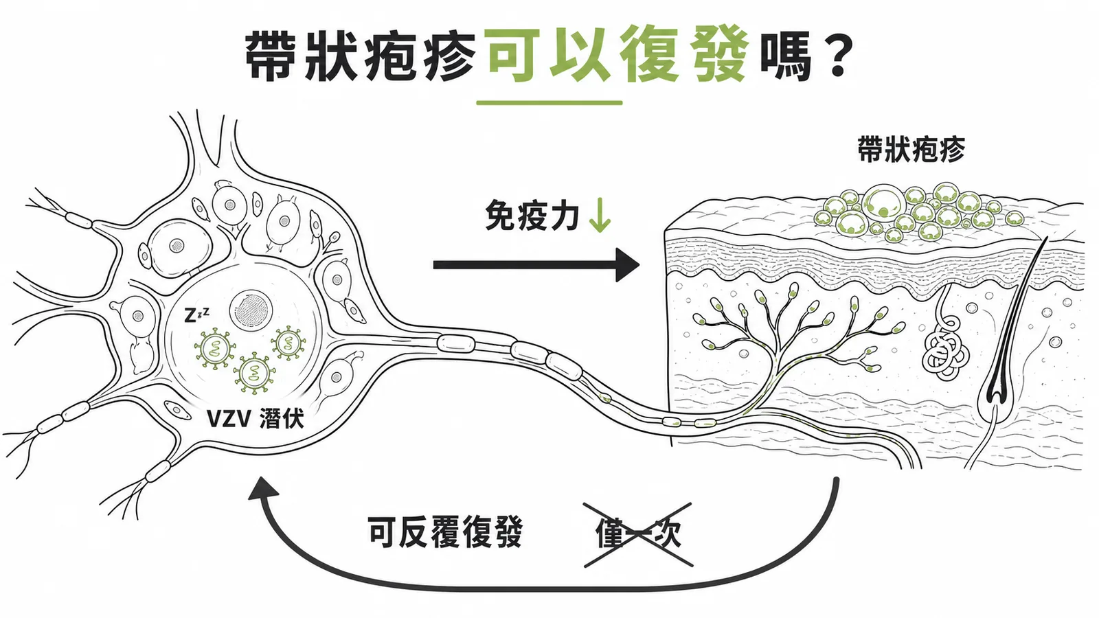 VZV潛伏於感覺神經節免疫力下降時帶狀疱疹可反覆復發