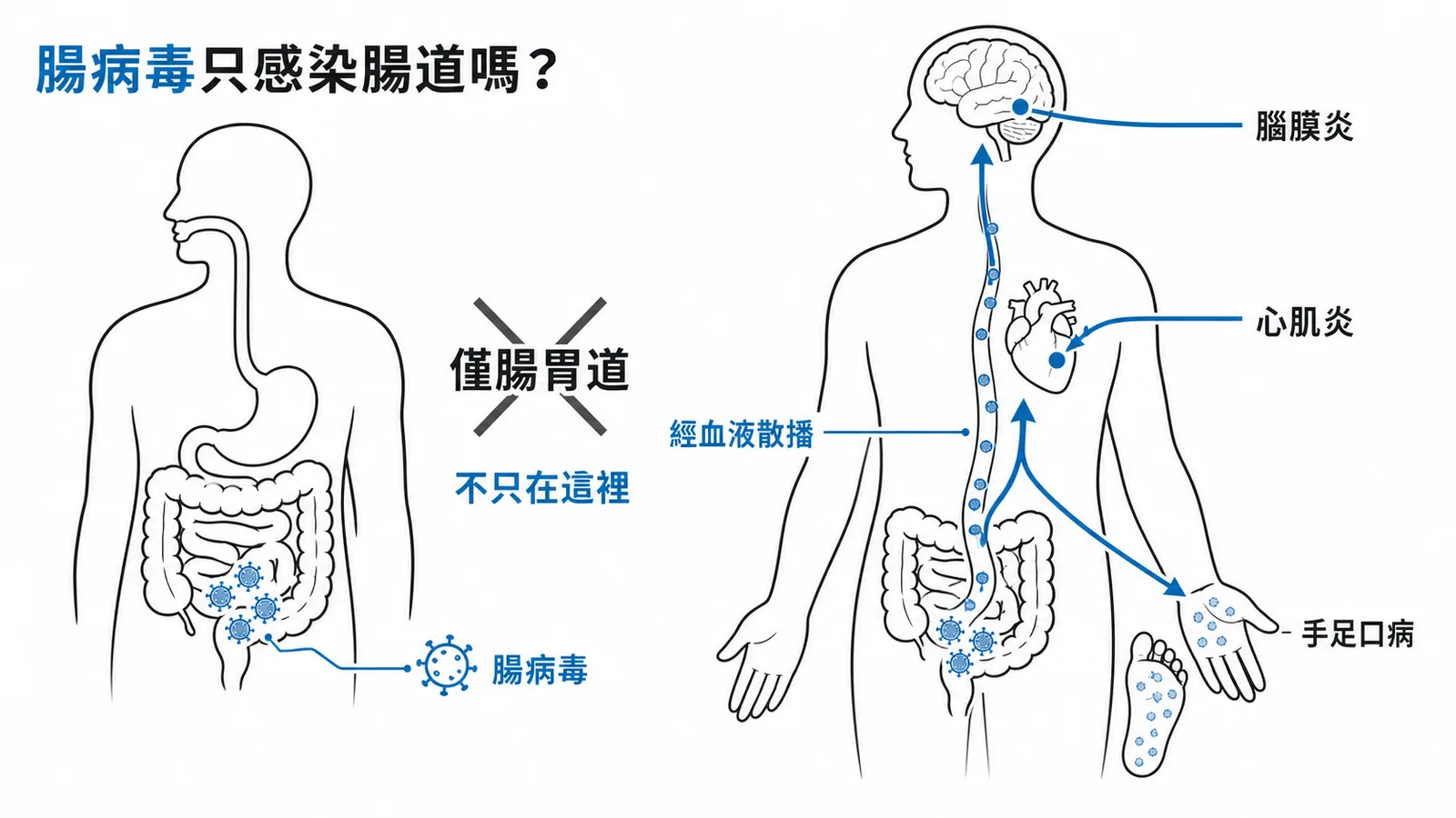 腸病毒經血液散播至腦心臟皮膚不只感染腸道
