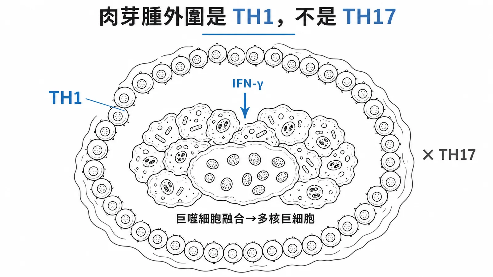 結核菌肉芽腫橫切面:外圍是 TH1 細胞分泌 IFN-γ 活化巨噬細胞,非 TH17