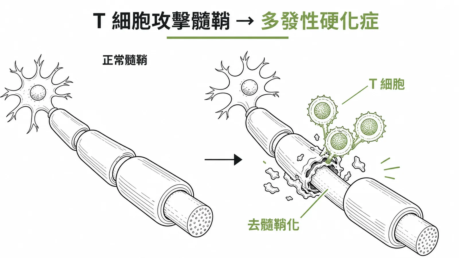 多發性硬化症:T 細胞攻擊中樞神經系統髓鞘導致去髓鞘化