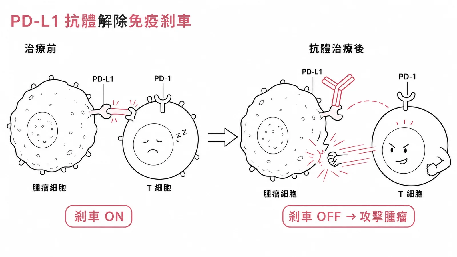 PD-L1 抗體阻斷腫瘤細胞 PD-L1 與 T 細胞 PD-1 結合,解除免疫剎車