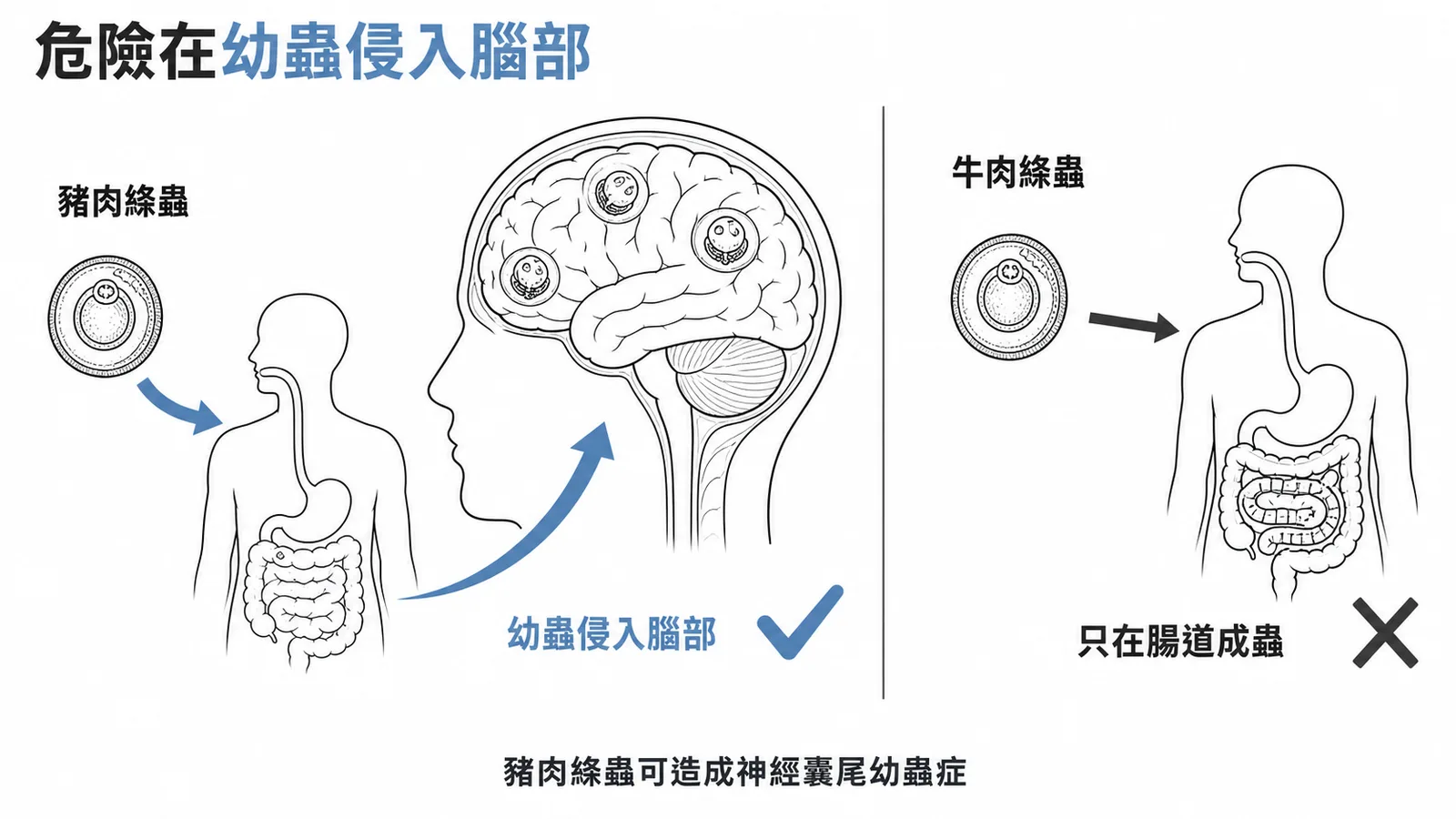 豬肉絛蟲幼蟲侵入腦部造成神經囊尾幼蟲症,牛肉絛蟲僅寄生腸道