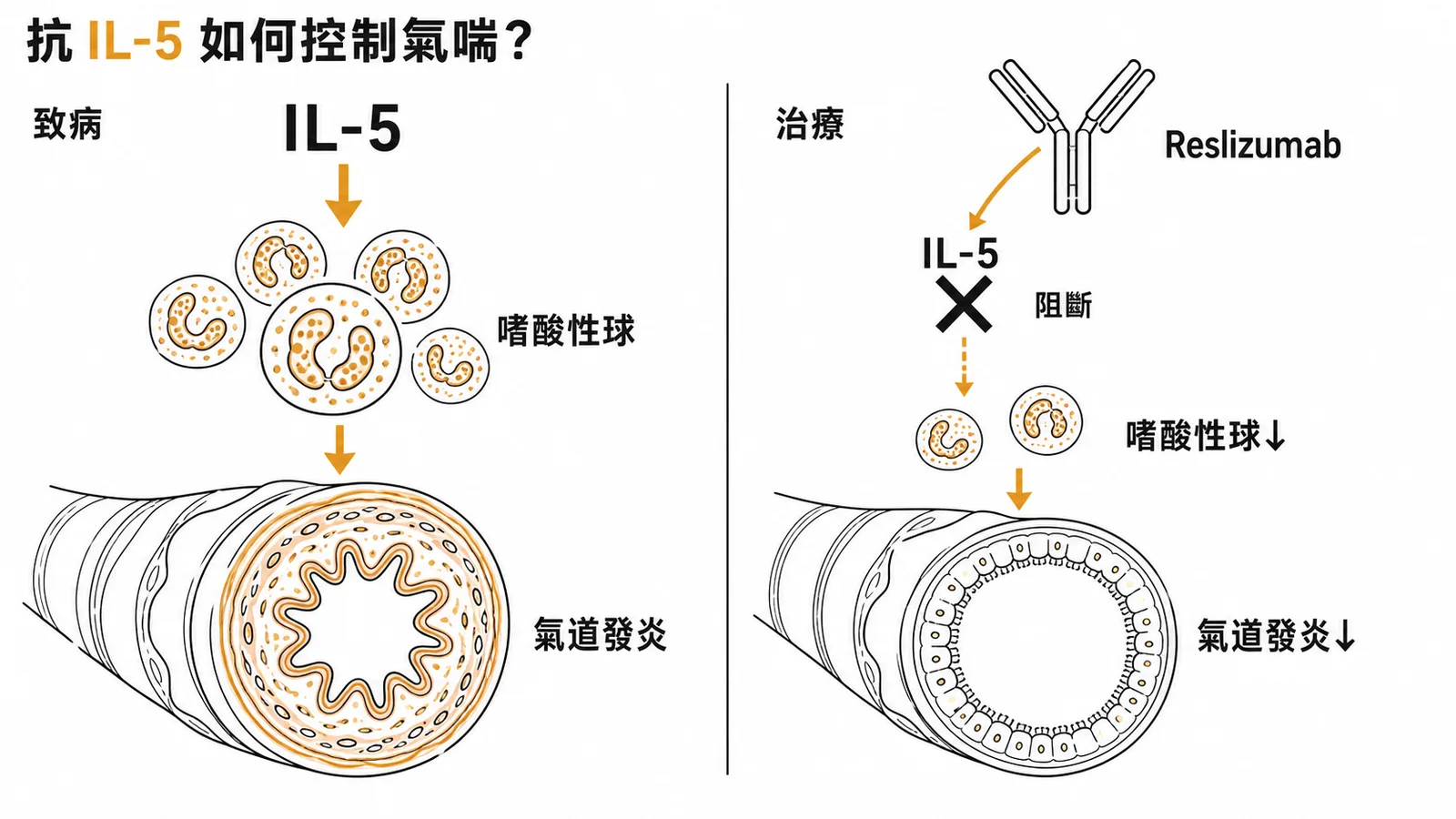 IL-5 驅動嗜酸性球造成氣道發炎，Reslizumab 為抗 IL-5 單株抗體，阻斷 IL-5 使嗜酸性球與氣道發炎減少，用於嗜酸性氣喘