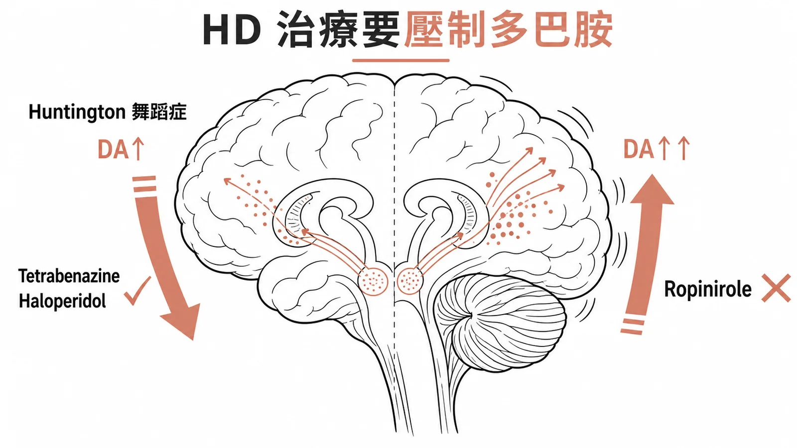 Huntington 舞蹈症治療:抑制多巴胺而非激活
