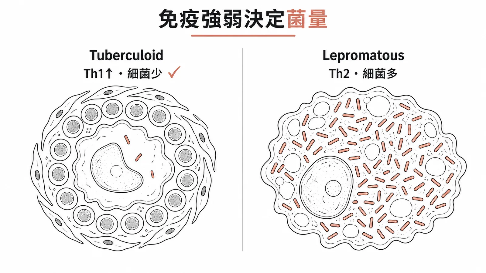 漢生病兩型對比:tuberculoid 細菌少 vs lepromatous 細菌多