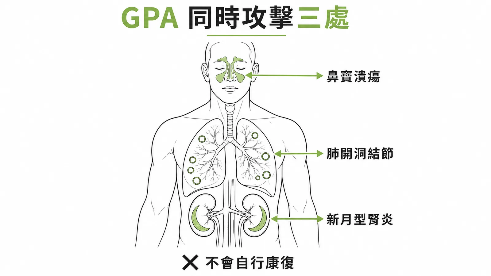 GPA 三重標靶：上呼吸道、肺、腎臟同時受侵犯，不治療無法自行康復