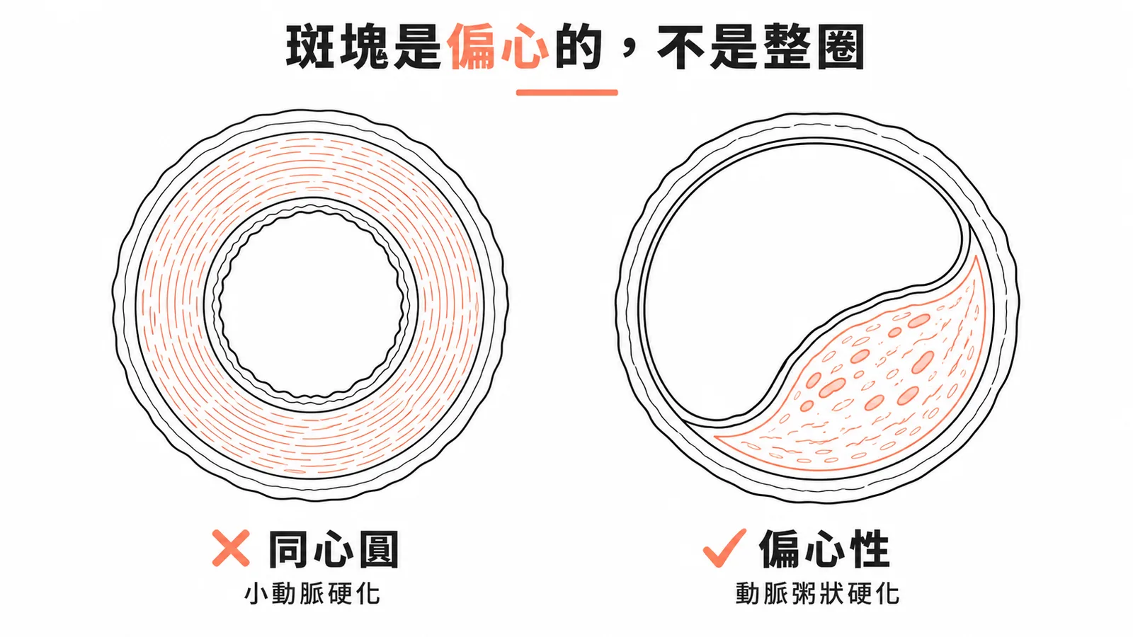 動脈粥狀硬化斑塊為偏心性增厚，非同心圓整圈增厚