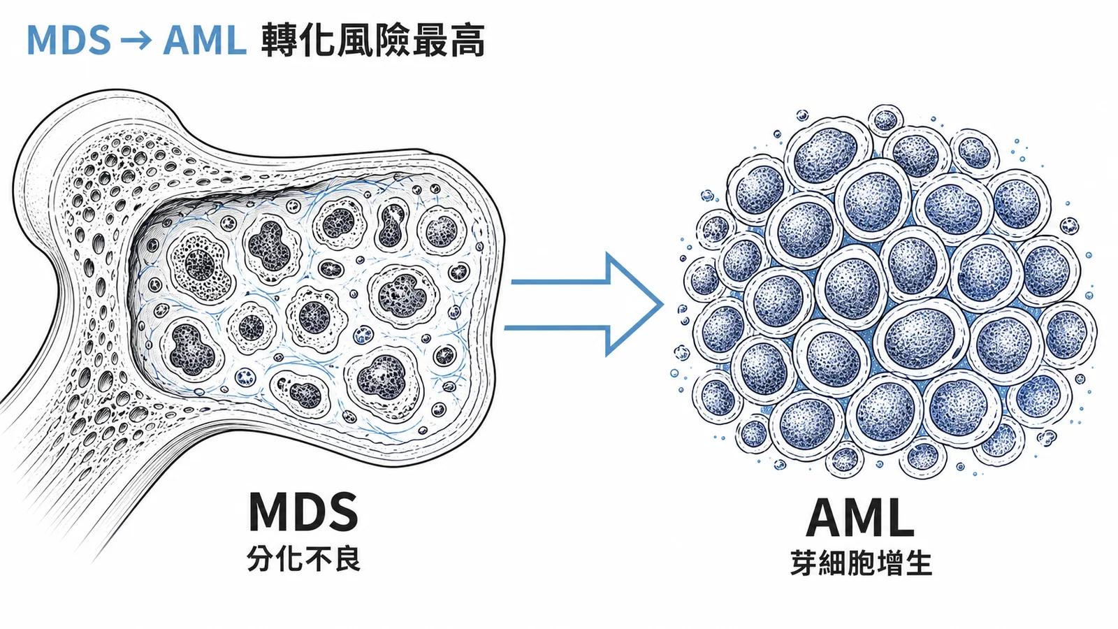 MDS 是 AML 最常見的前驅疾病，轉化風險最高