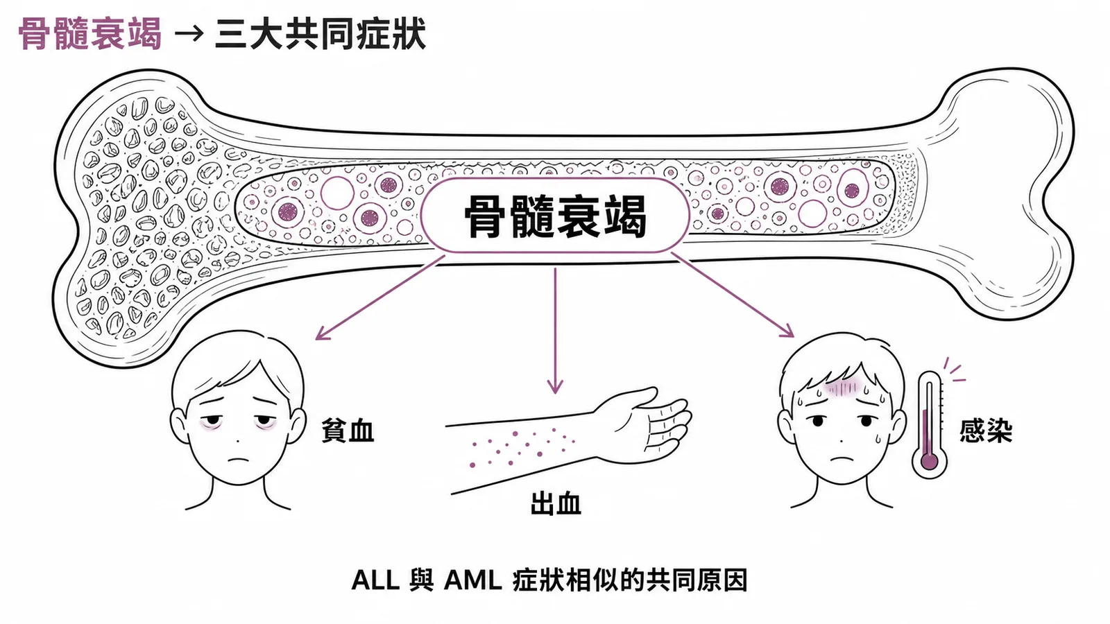 ALL 與 AML 骨髓衰竭症狀相似：貧血、出血、感染