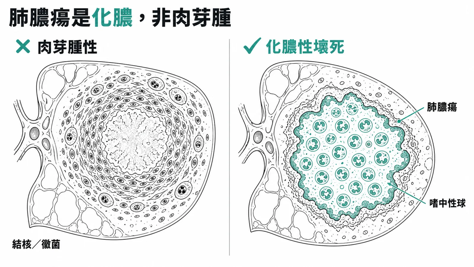 肺膿瘍是化膿性壞死，非肉芽腫性發炎