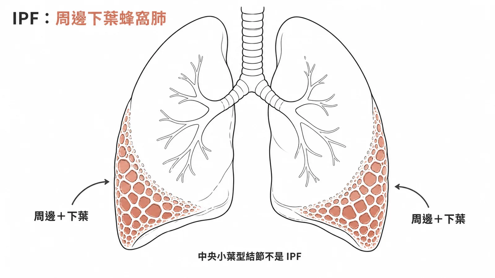 IPF 典型 CT 表現為周邊下葉蜂窩肺，非中央小葉型結節
