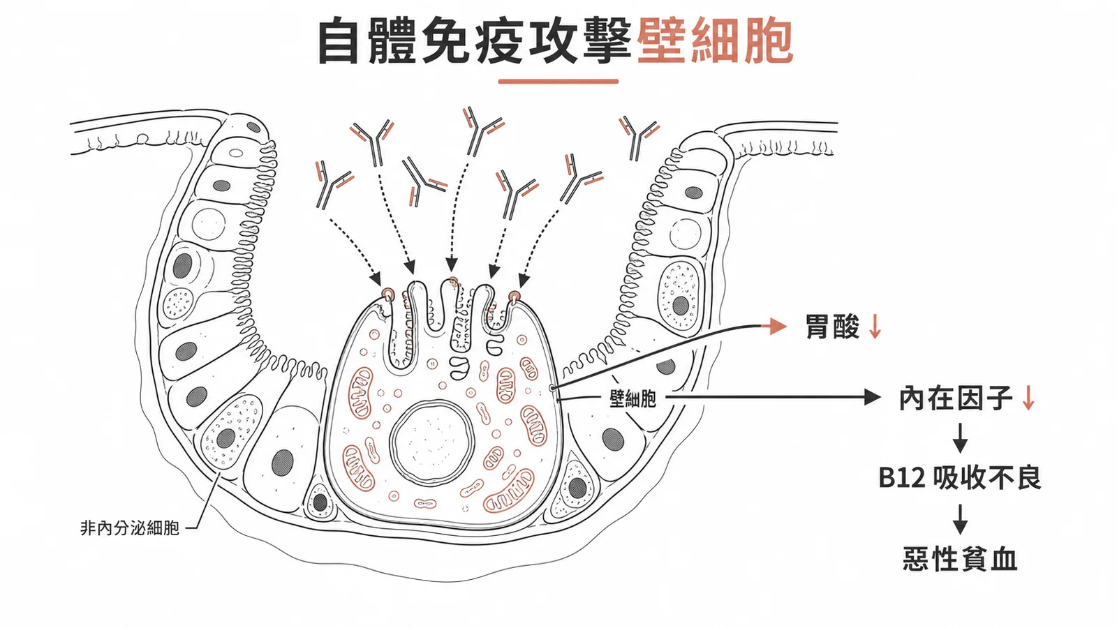 自體免疫萎縮性胃炎攻擊壁細胞，非內分泌細胞