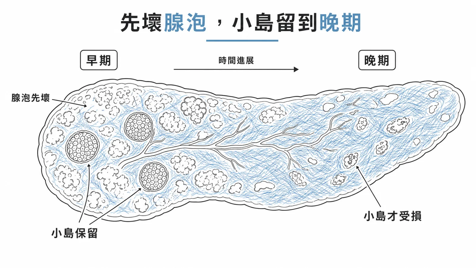 慢性胰臟炎先破壞腺泡，蘭氏小島晚期才受損