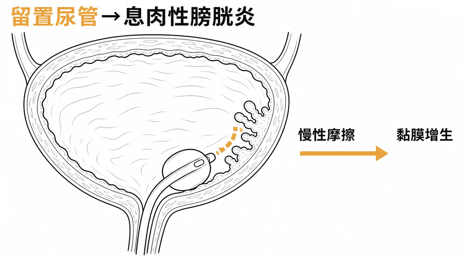 留置尿管導致膀胱黏膜慢性刺激形成息肉性膀胱炎示意圖