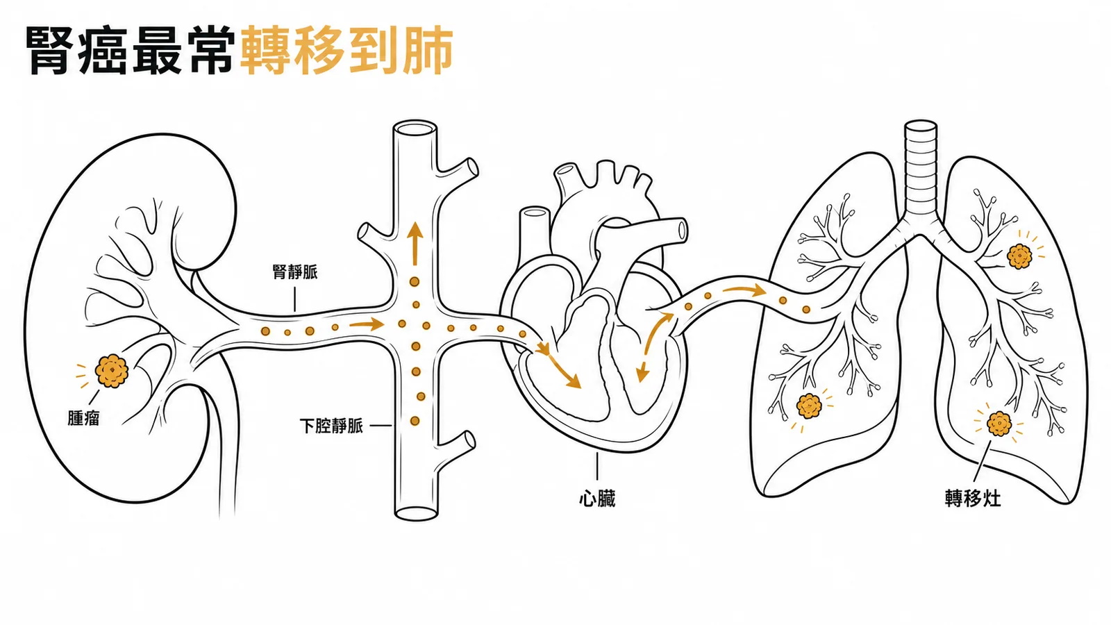腎透明細胞癌經腎靜脈血行轉移至肺臟的路徑示意圖