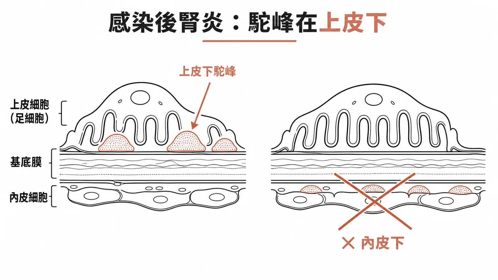 腎絲球基底膜各層免疫沉澱物位置示意圖：上皮下駝峰與內皮下的差異