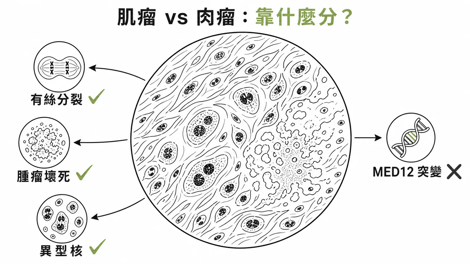 鑑別子宮平滑肌瘤與平滑肌肉瘤的三大病理指標示意圖