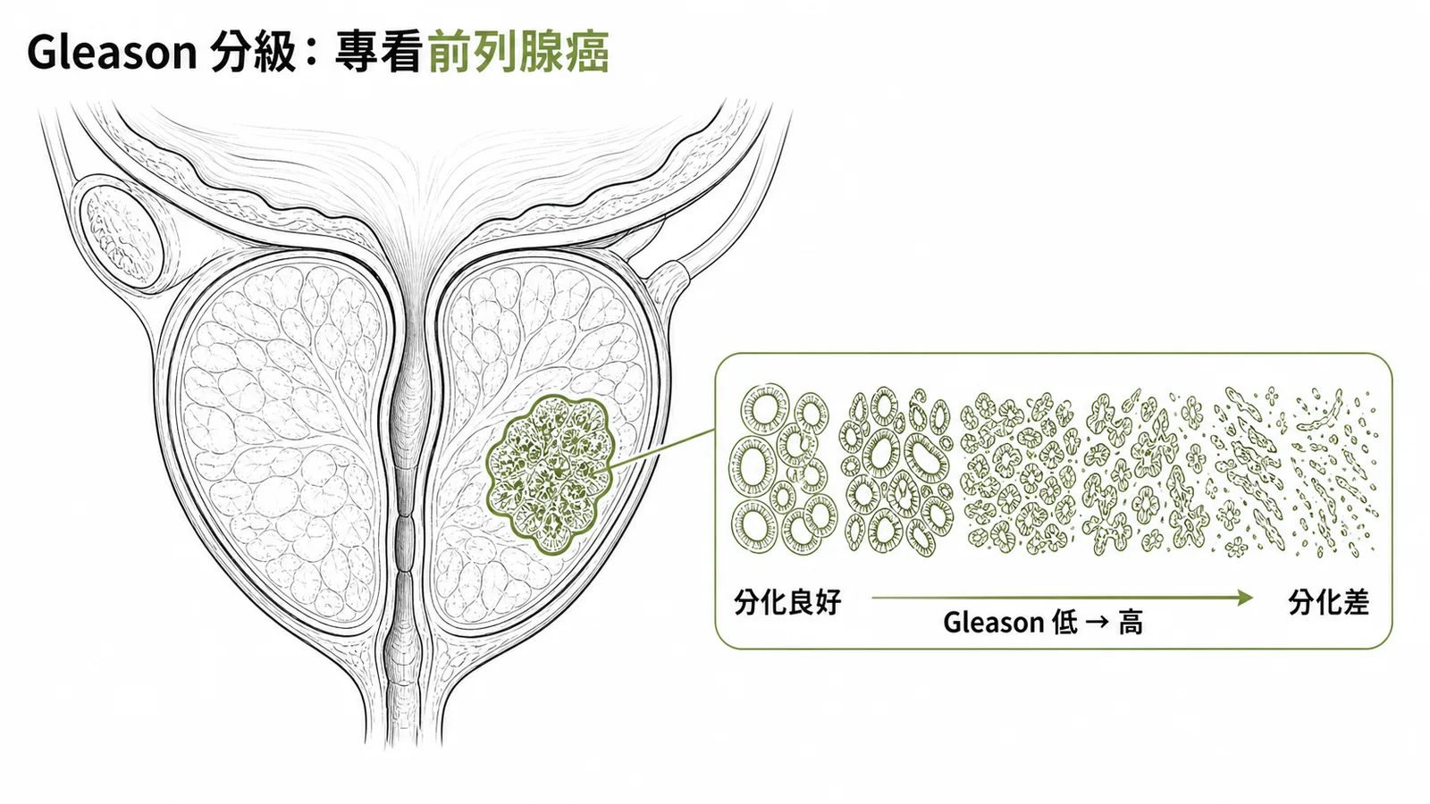 Gleason grade 前列腺癌分級系統：腺體分化程度由好到差示意圖