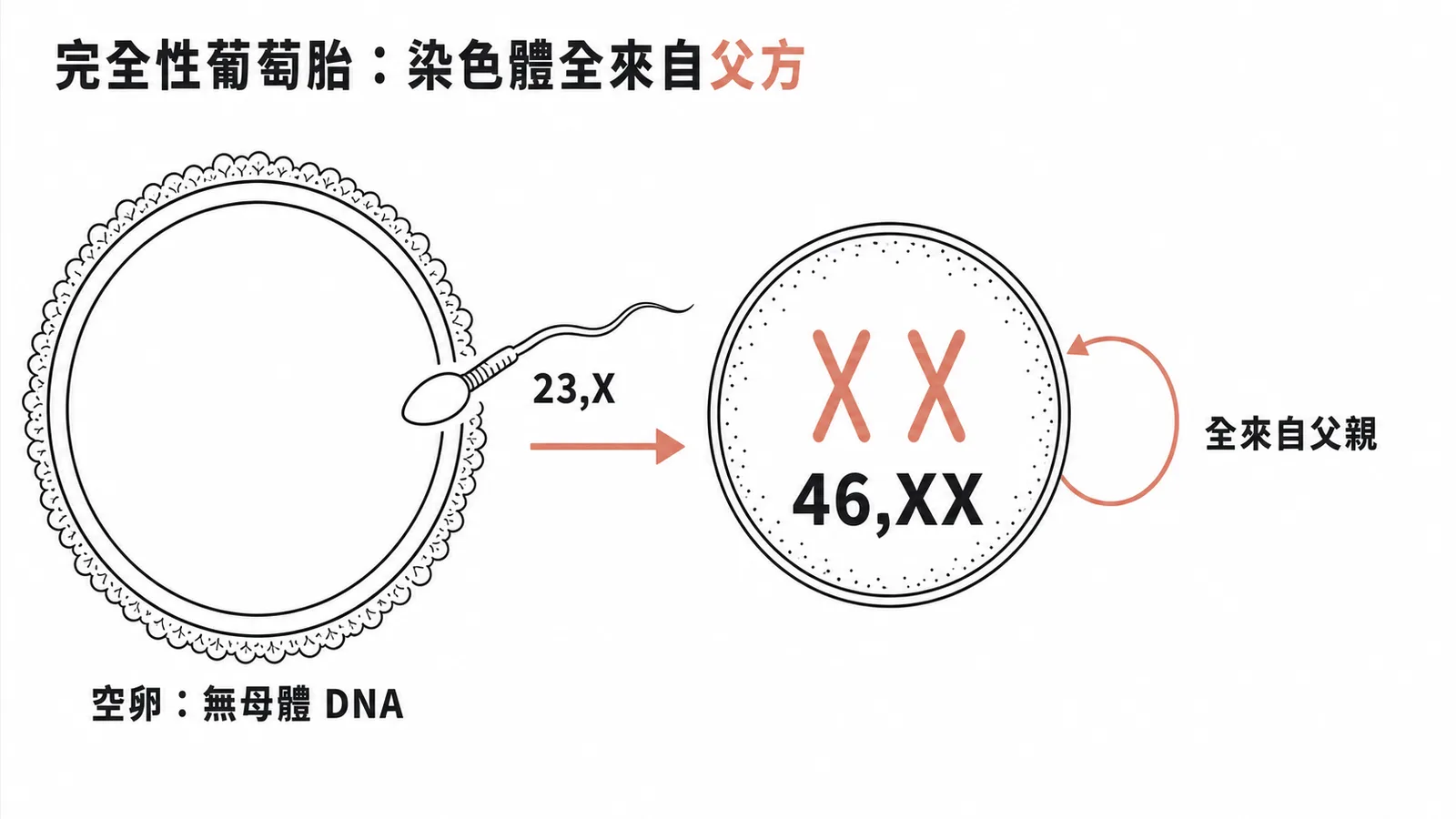 完全性葡萄胎形成機制：空卵受精後精子染色體自我複製為46,XX示意圖