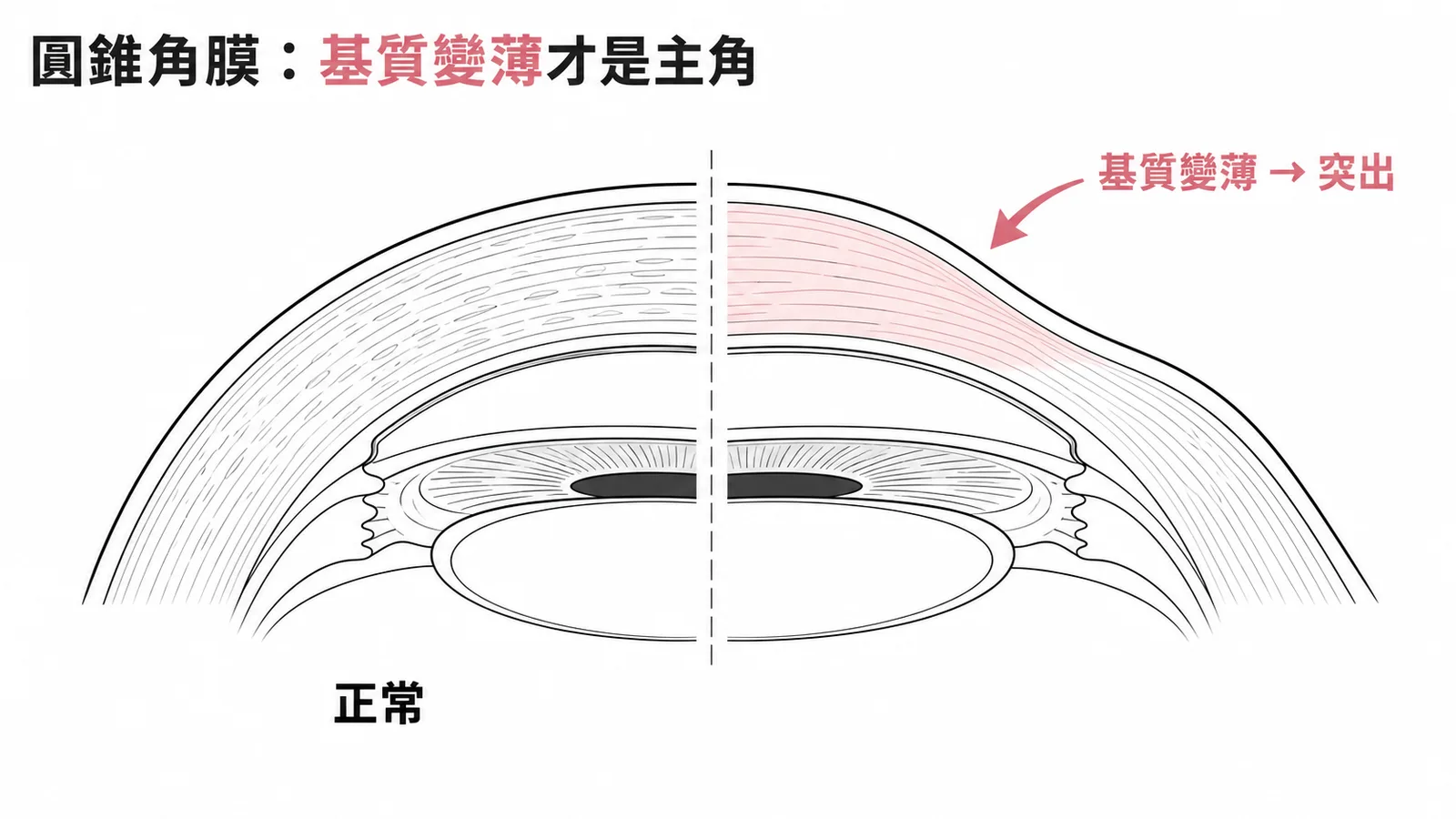 圓錐角膜主要病理特徵：角膜基質變薄向前突出示意圖