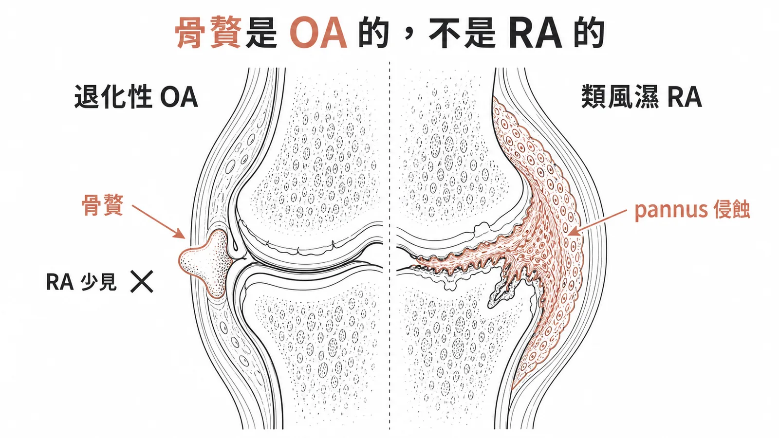 骨贅是退化性關節炎OA標誌而非類風濕性關節炎RA病理特徵對照圖