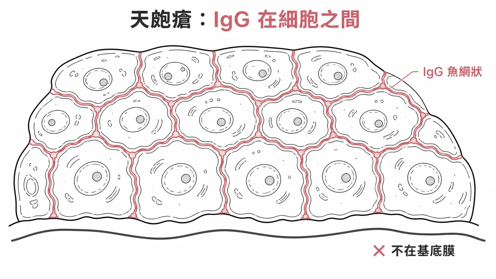 天皰瘡IgG沉積在表皮細胞之間呈魚網狀螢光示意圖