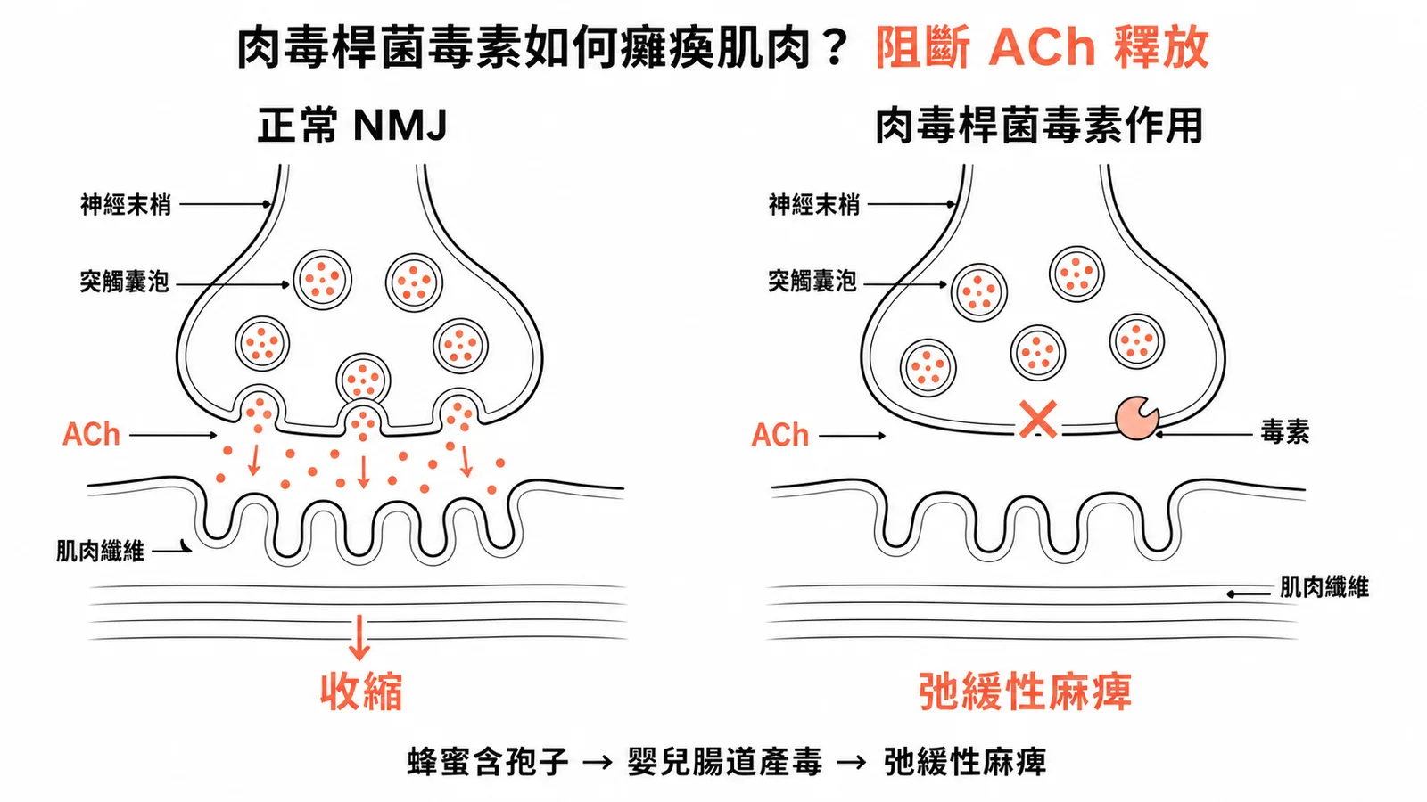 肉毒桿菌毒素阻斷神經肌肉接合處ACh釋放導致弛緩性麻痺