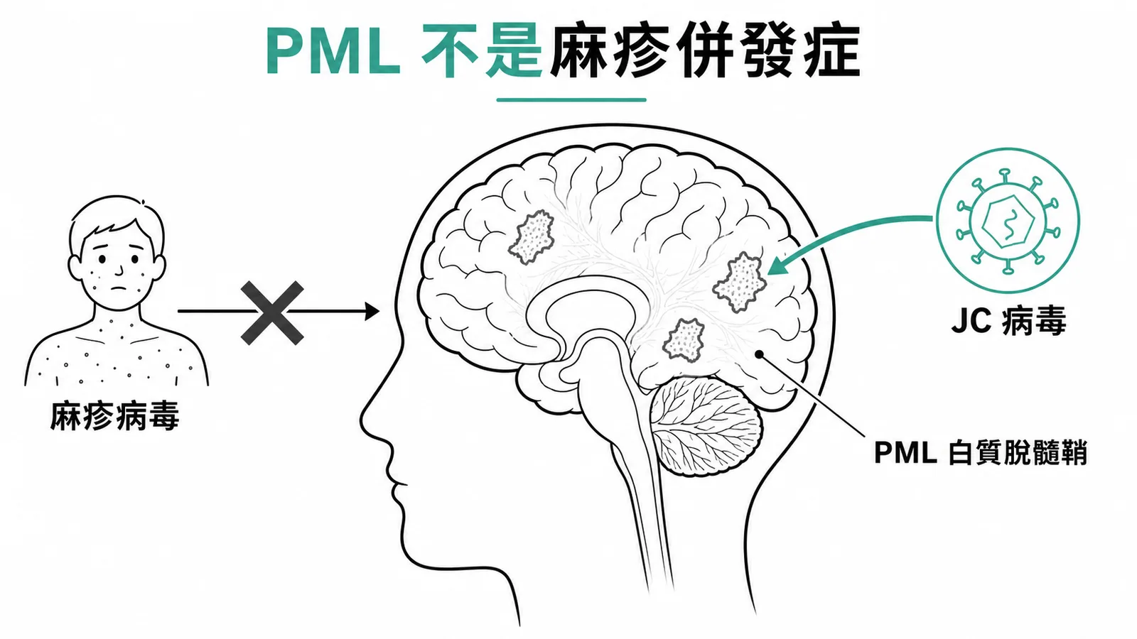 PML非麻疹併發症:PML由JC病毒引起,與麻疹病毒無關