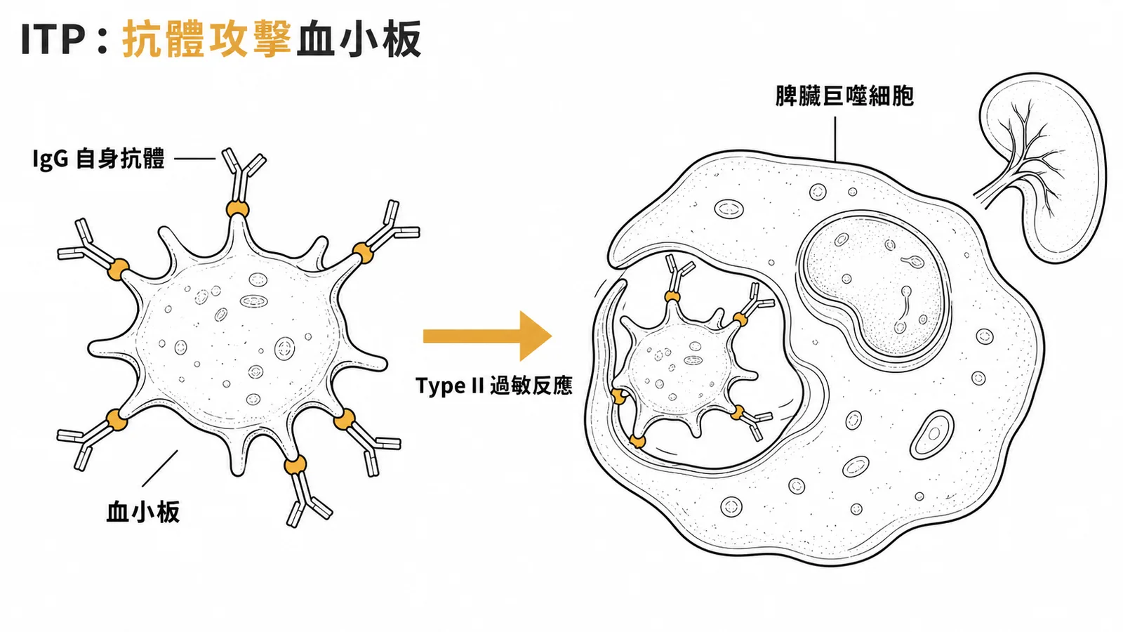 ITP 自身抗體攻擊血小板被巨噬細胞吞噬的 Type II 過敏反應示意圖