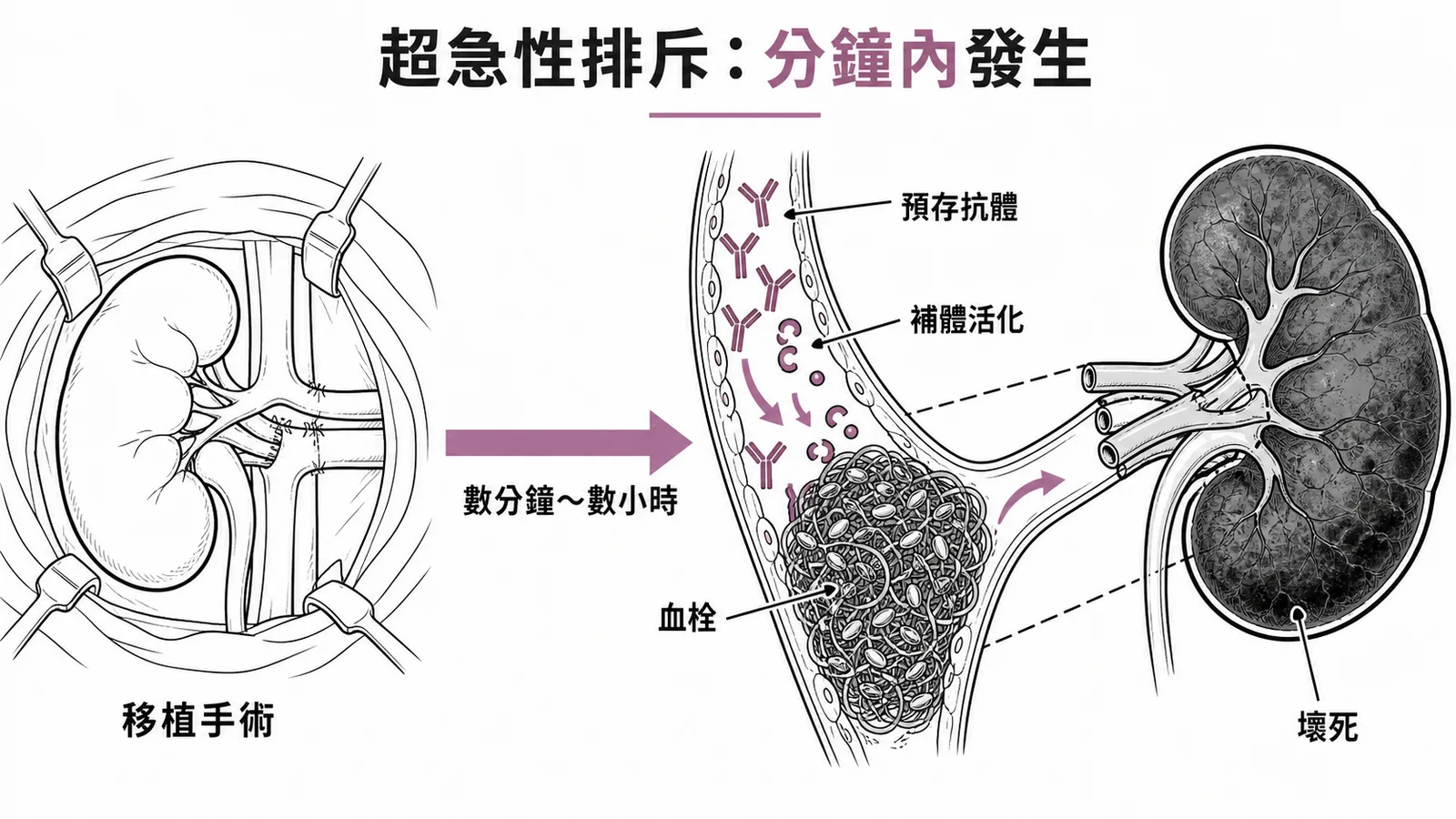 超急性排斥反應預存抗體攻擊移植物血管示意圖