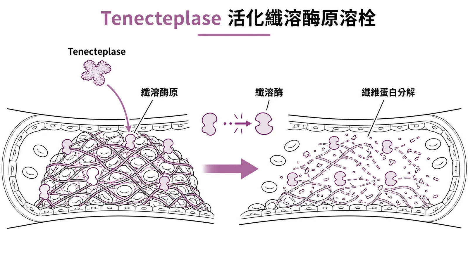 Tenecteplase 活化纖溶酶原溶栓示意圖