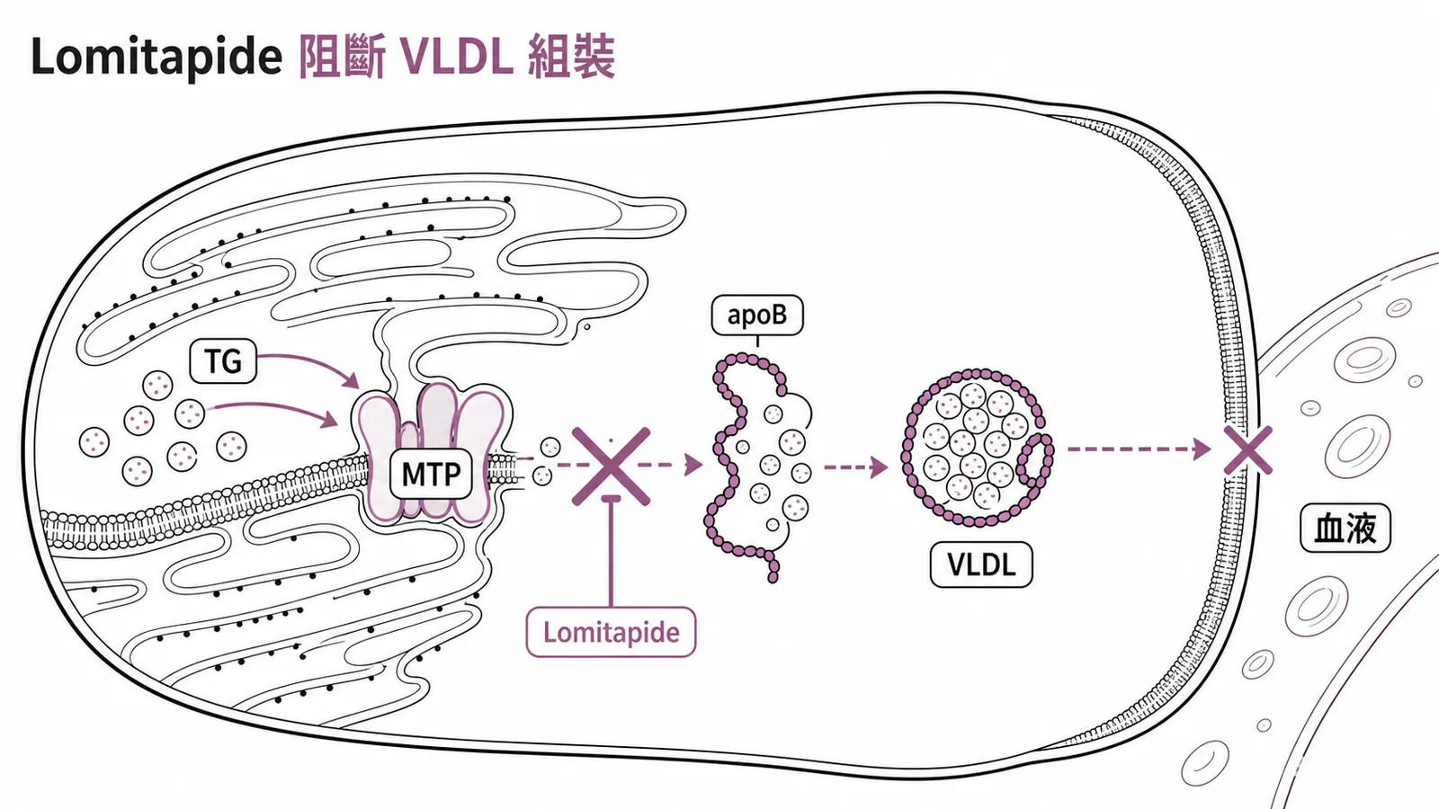 Lomitapide 抑制 MTP 阻斷 VLDL 組裝示意圖